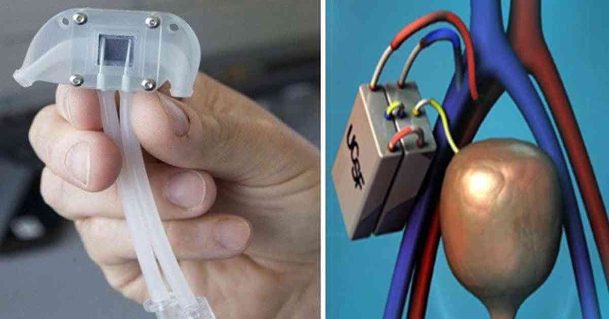 تطوير كلية اصطناعية تغني عن غسيل الكلى وأدوية المناعة