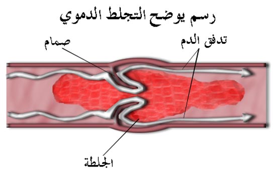 عاملٌ يزيد من خطر الإصابة بتجلّط الدم