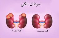 كشف أولى علامات سرطان الكلى