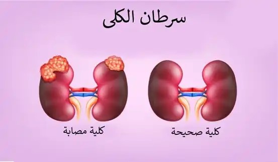كشف أولى علامات سرطان الكلى