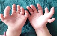طفلة بــ 14 اصبعاً