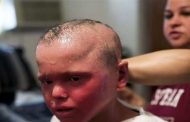 الأطفال يرفضون اللعب معه وأقاربه نصحوه بالانتحار: قصة صبي يخلع جلده كالأفعى