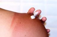 6 نصائح مهمة لاستخدام مراهم حروق الشمس