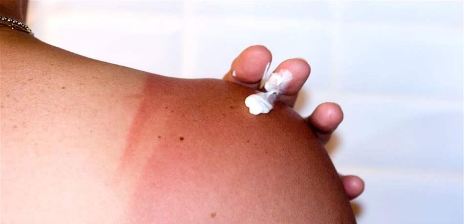 6 نصائح مهمة لاستخدام مراهم حروق الشمس