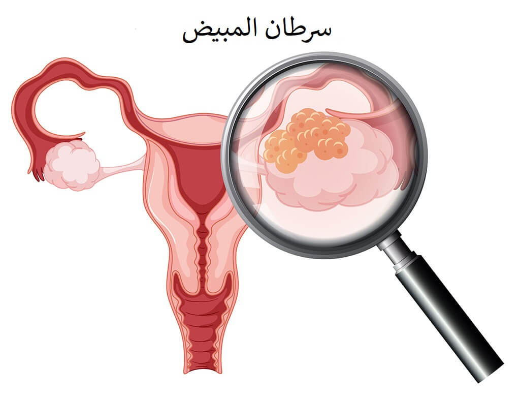 5 علامات تحذيرية غريبة لسرطان المبيض
